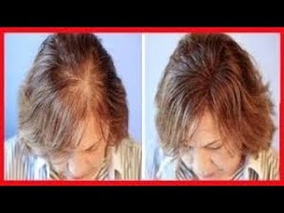Calvicie - alopecia androgentica: calvcie feminina  - mulheres