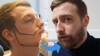 Beard Transplant - Jays Complete journey to a Full Beard (before / after)